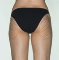 La terapia microchirurgica delle smagliature 