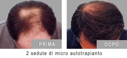 REINFOLTIMENTO CAPELLI - Trapianto capelli: rinfoltire dove serve 